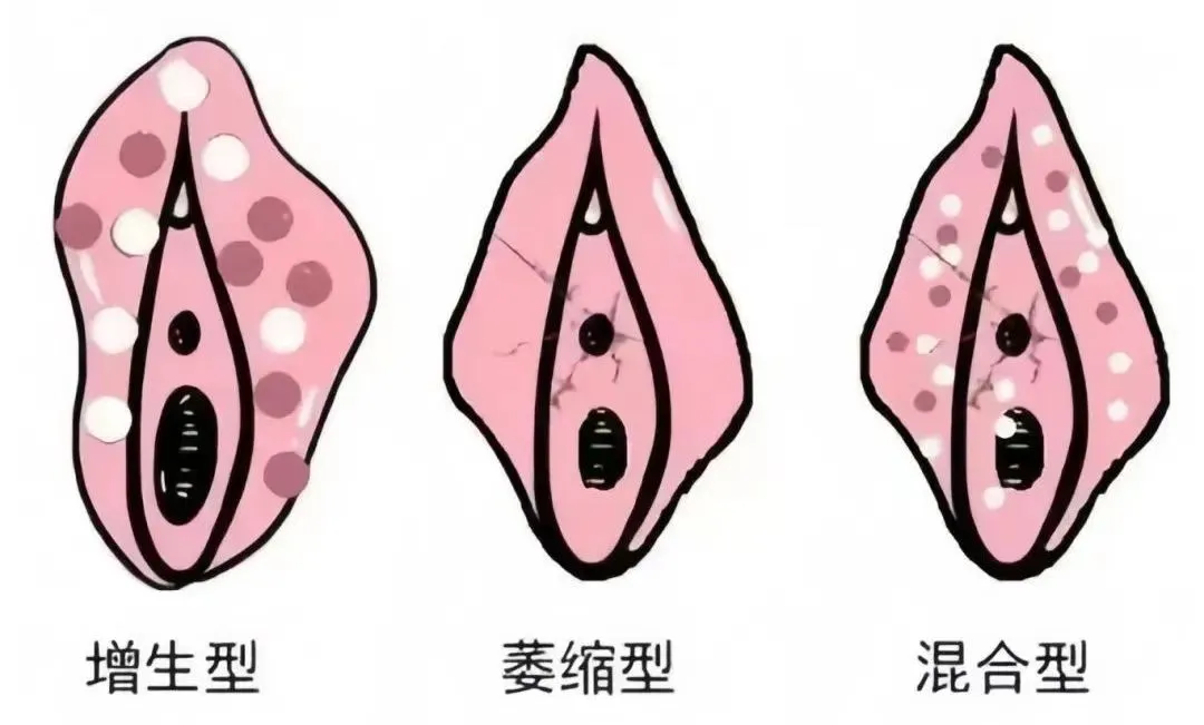 外阴白斑治疗一般用什么药？